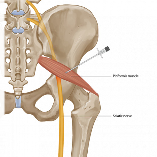 priformis enjeksiyonu