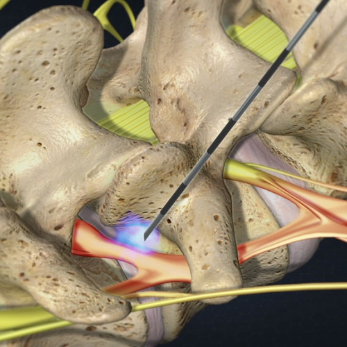 Bel Lomber Epidural