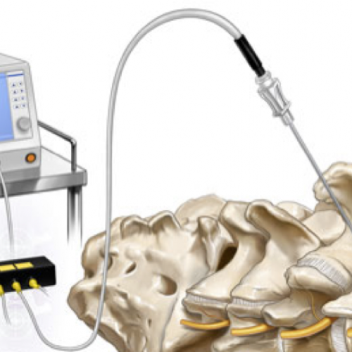 Bel ve Boyun Fıtıklarında Darbeli Radyofrekans Tedavisi